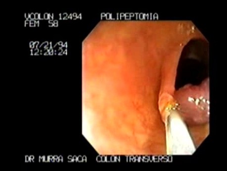 Endoscopic snare excision of large pediculated Polyp (4 of 5)