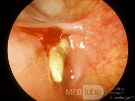 Foreign Body In Maxillary Sinus