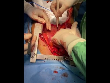 Bilateral Lung Harvest and Transplantation Technical Consideration 
