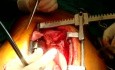 Cabg - Total Arterial Awake Off Pump Coronary Artery Bypass Grafting 
