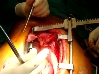 Cabg - Total Arterial Awake Off Pump Coronary Artery Bypass Grafting 