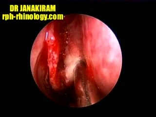 Unusual Presentation Of Nasal Polyp