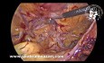 Left Incisional Recurrent Inguinal Hernia Repair