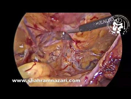 Left Incisional Recurrent Inguinal Hernia Repair