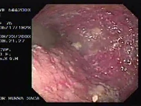 Esophageal Achalasia  (2 of 16)