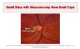 Five Rules for the Assessment of Optic Disc in Glaucoma