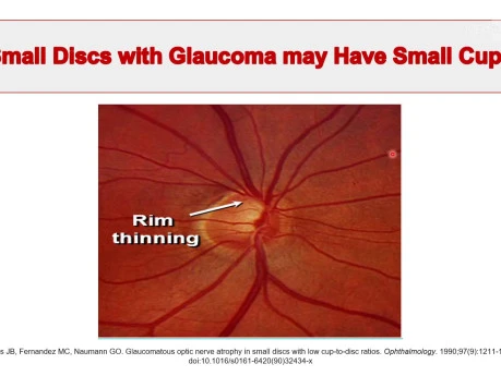 Five Rules for the Assessment of Optic Disc in Glaucoma