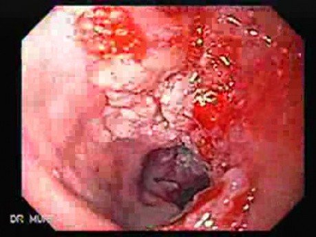 Esophageal Squamous Cell Carcinoma of the the Upper Third of the Esophagus - Large and Ulcerated Carcinoma