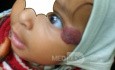 Hemangioma