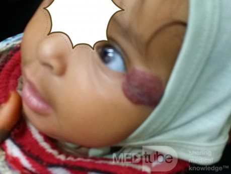 Hemangioma