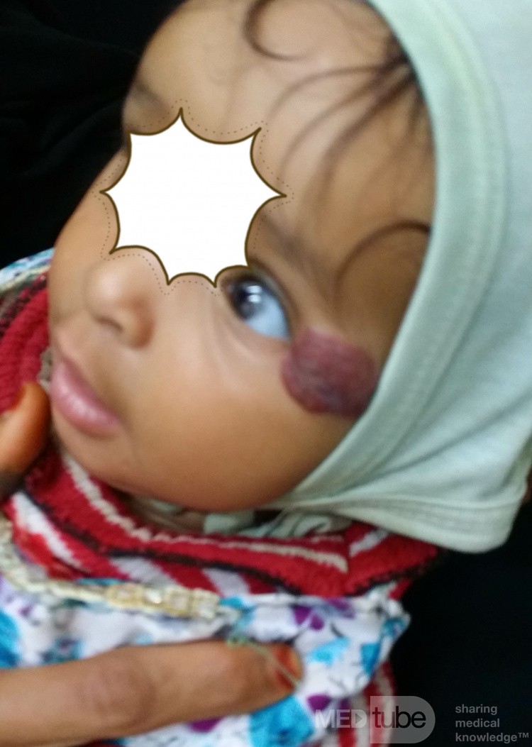 Hemangioma