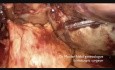 Adnexal Necrosis After Ovarian Torsion 