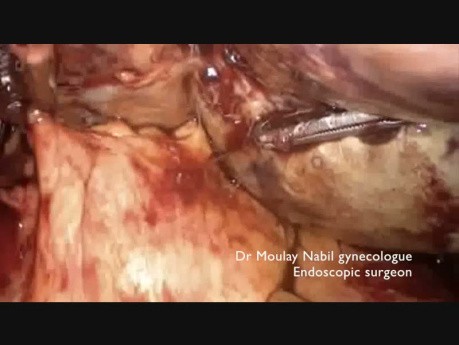 Adnexal Necrosis After Ovarian Torsion 