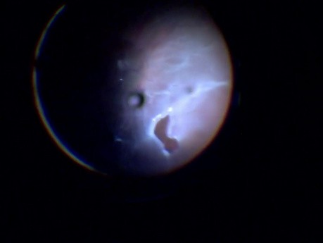 25g PPV for Singe Hole PVR B Retinal Detachment - Full Surgery (High-speed)