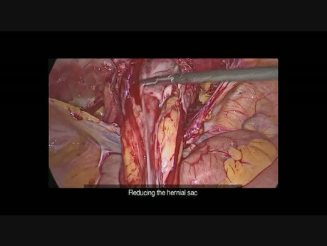 Laparoscopic Inguinal Trans Abdominal Pre Peritoneal (TAPP) Mesh Hernioplasty - Step by Step