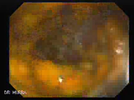 Pseudomembranous Colitis (1 of 11)