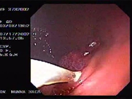 Polypectomy (6 of 6)