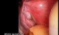 Diagnostic Laparoscopy