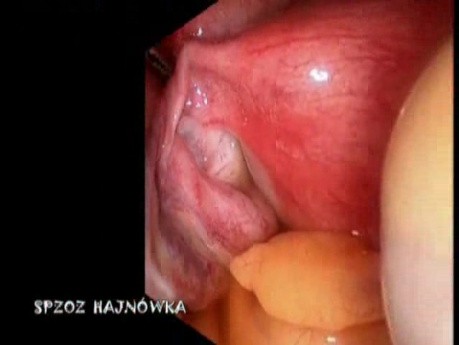 Diagnostic Laparoscopy