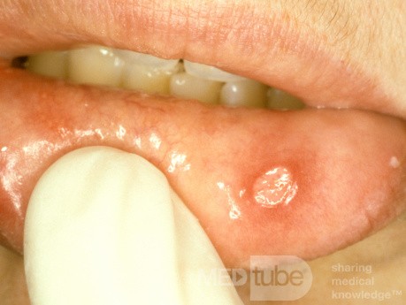 Apthous Ulcer