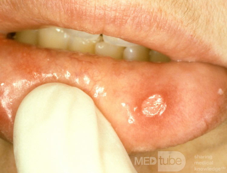 Apthous Ulcer