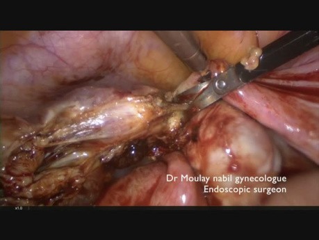 Emergency Laparoscopy for Ectopic Pregnancy