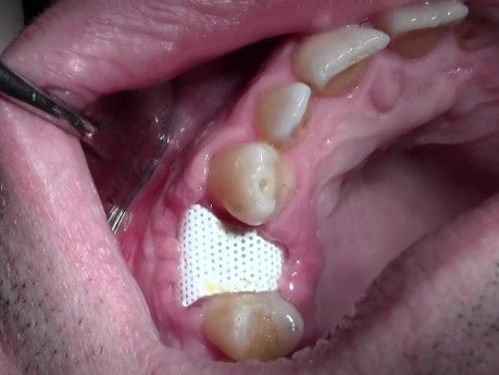 Bone Grafting #5 Site - Mineross/Cytoplast d-PTFE - 2 Week p-o