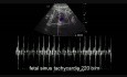 Fetal Sinus Tachycardia Case