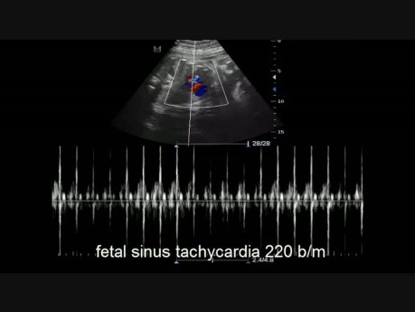 Fetal Sinus Tachycardia Case