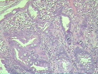 Case on Multiple Adenomas (large polyps) of the Rectum (33 of 37)