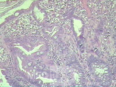 Case on Multiple Adenomas (large polyps) of the Rectum (33 of 37)