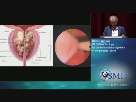 REZUM-technology for Transurethral Management of the Prostate - SMIT 2019