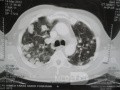 Chest Metastasis Due To Renal Cell Carcinoma