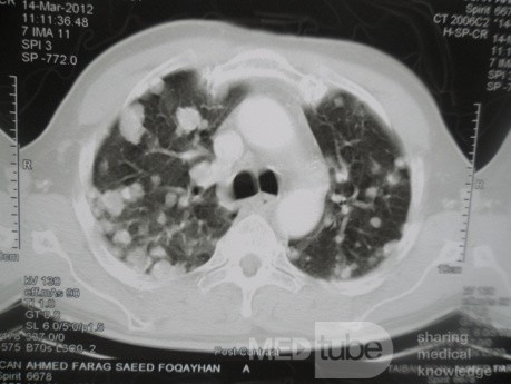 Chest Metastasis Due To Renal Cell Carcinoma