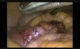 Laparoscopic Resection Of Bleeding Meckel`s Diverticulum-uncut video