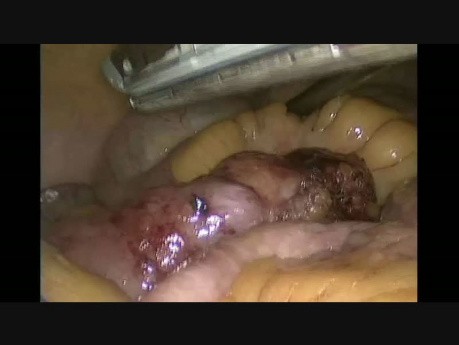 Laparoscopic Resection Of Bleeding Meckel`s Diverticulum-uncut video