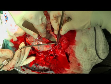 Acute Subdural Hematoma