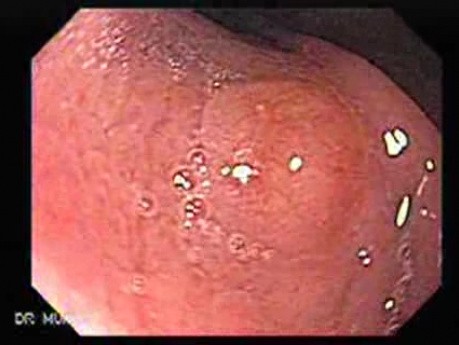 Gastric Carcinoid Tumor (2 of 4)