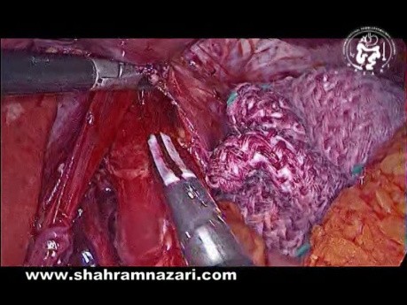 Operative Steps Laparoscopic Hiatal Hernia Repair
