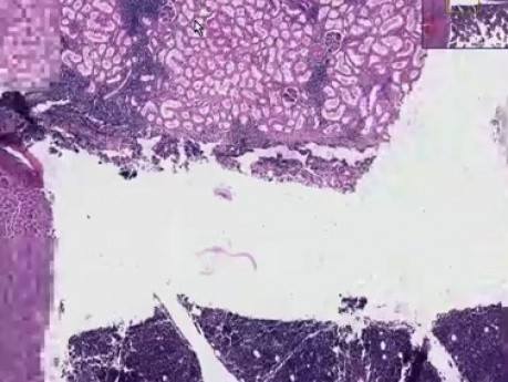 Chronic lymphocytic leukemia - Histopathology - Lymph node, bone marrow, liver, kidney