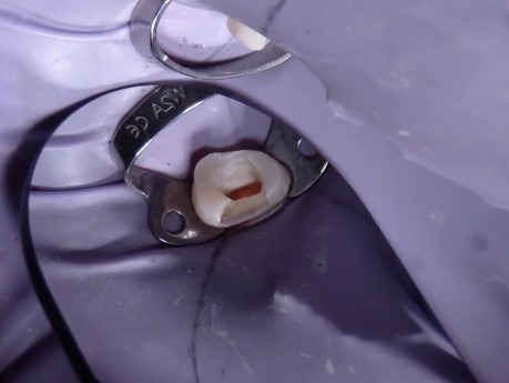 Post Endodontic Treatment #5 Comp Case #2