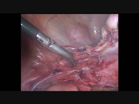 Laparoscopic Hysterectomy Chronic Pelvic Pain