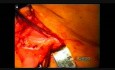 No Mesh Direct Inguinal Hernia Repair -  Desarda Technique
