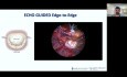 Echo & Minimally Invasive Cardiac Surgery (MCIS) For The Mitral Valve - What We Should Know