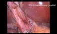 Laparoscopic cholecystectomy