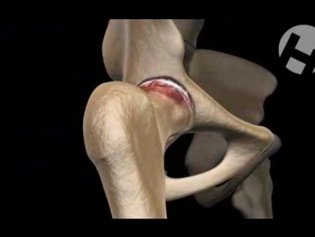 Total Hip Replacement