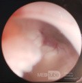 Endoscopic Third Ventriculostomy in a Benign Case of Aicardi Syndrome with Obstructive Hydrocephalus and Chiari Malformation type 1