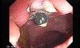 Rubber Band Ligation of Hemorrhoids (1 of 3)