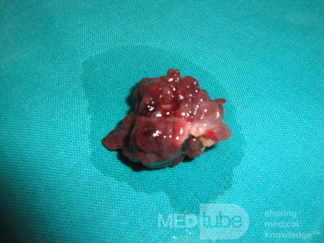 Giant Multilobulated Gastric Polyp (18 of 20)