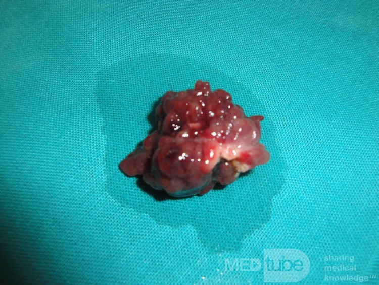 Giant Multilobulated Gastric Polyp (18 of 20)